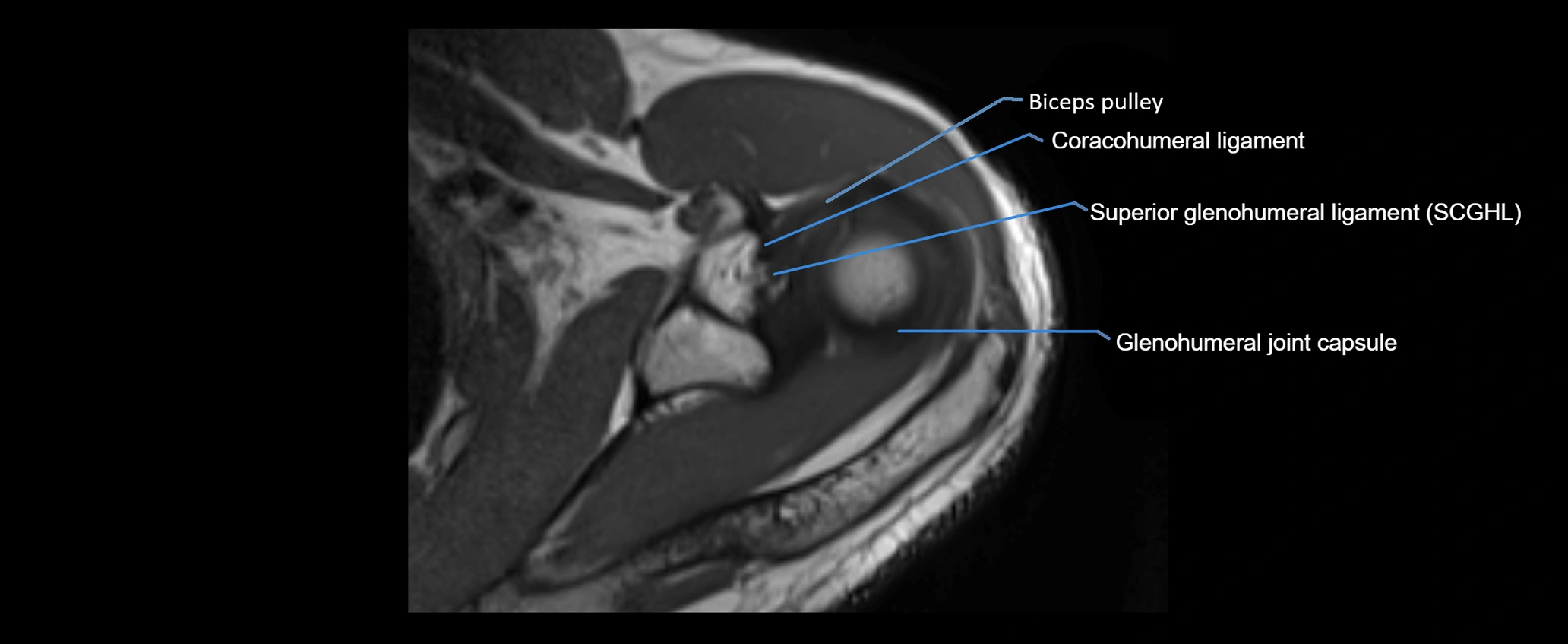 shoulder ligaments axial 3d 3t mri image-img-00005-00043.webp